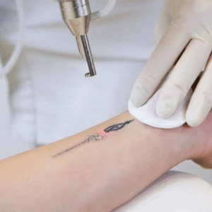 Tatoo Removal Course & Laser Machine